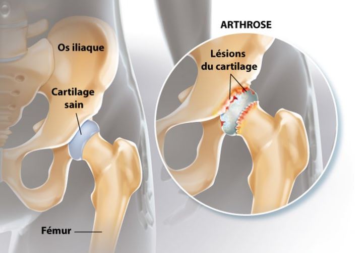 Arthrose de hanche